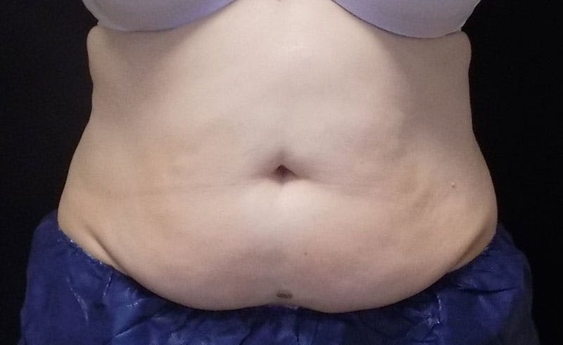 Female Abs Before & After Gallery - Patient 407268 - Image 1