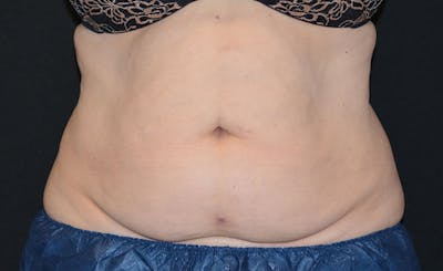 Female Abs Before & After Gallery - Patient 407268 - Image 2