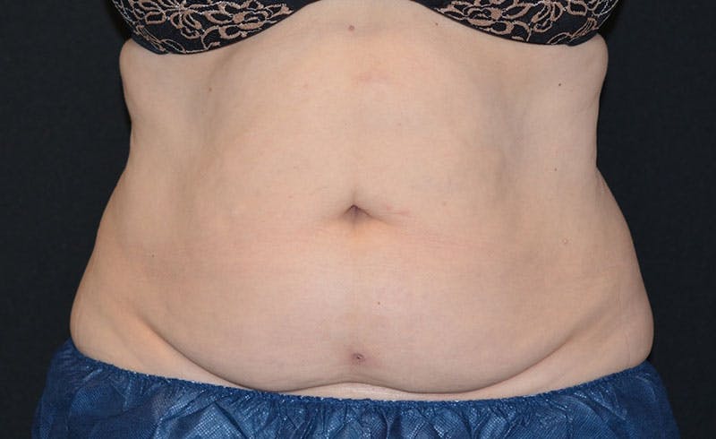 Female Abs Before & After Gallery - Patient 407268 - Image 2