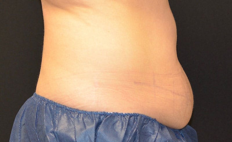 Female Abs Before & After Gallery - Patient 426468 - Image 1