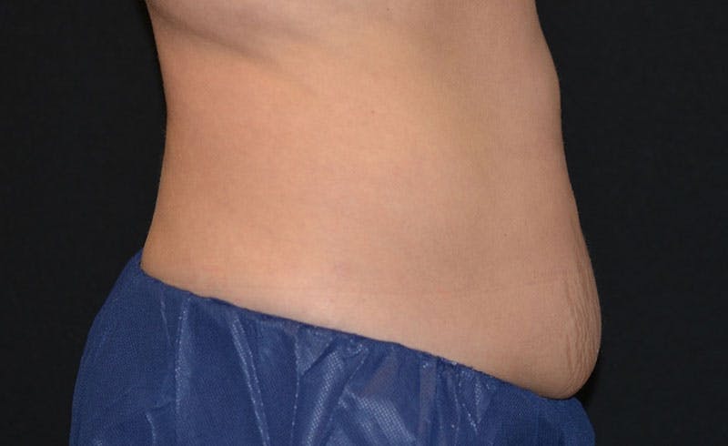 Female Abs Before & After Gallery - Patient 426468 - Image 2
