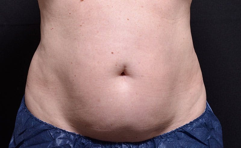 Female Abs Before & After Gallery - Patient 369320 - Image 1
