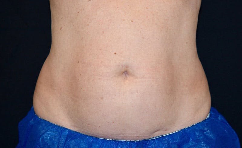 Female Abs Before & After Gallery - Patient 369320 - Image 2