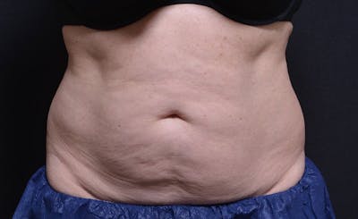 Female Abs Before & After Gallery - Patient 384761 - Image 1