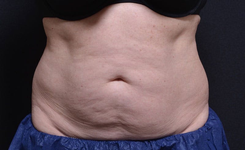 Female Abs Before & After Gallery - Patient 384761 - Image 1