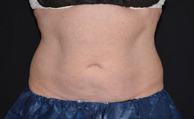 Female Abs Before & After Gallery - Patient 384761 - Image 2