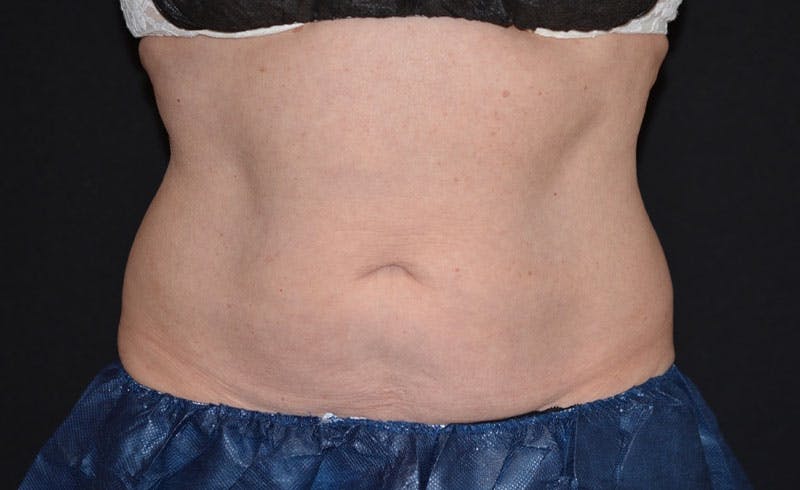 Female Abs Before & After Gallery - Patient 384761 - Image 2