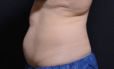 Female Abs Before & After Gallery - Patient 387750 - Image 1