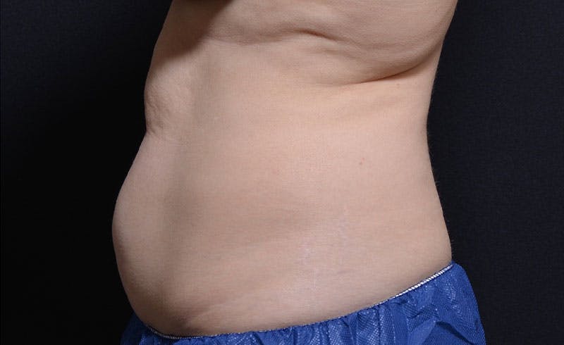 Female Abs Before & After Gallery - Patient 387750 - Image 1