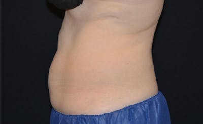 Female Abs Before & After Gallery - Patient 387750 - Image 2