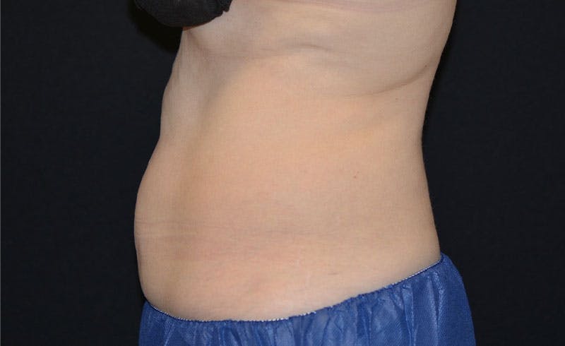 Female Abs Before & After Gallery - Patient 387750 - Image 2