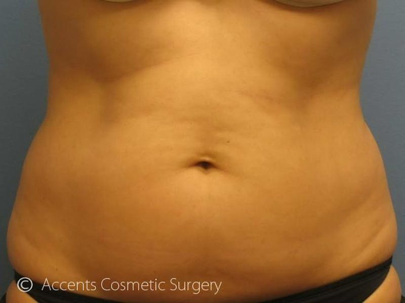 Female Abs Before & After Gallery - Patient 880361 - Image 1