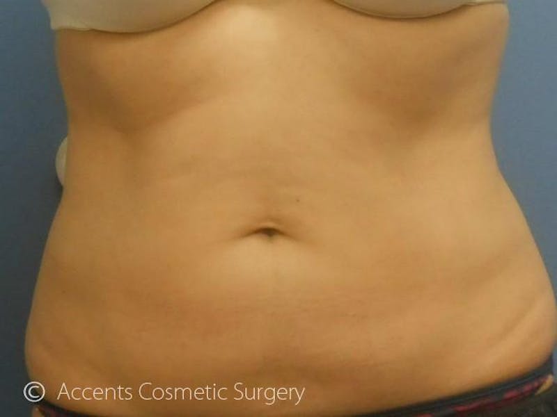 Female Abs Before & After Gallery - Patient 880361 - Image 2