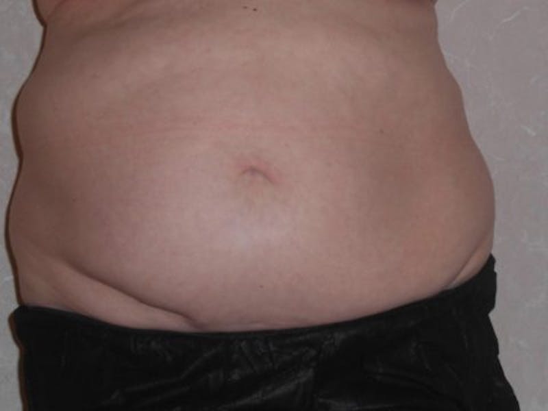 Female Abs Before & After Gallery - Patient 152485 - Image 1
