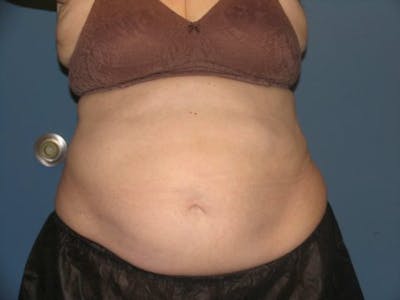 Female Abs Before & After Gallery - Patient 152485 - Image 2