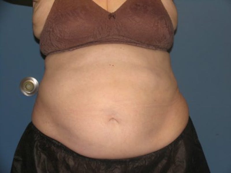 Female Abs Before & After Gallery - Patient 152485 - Image 2