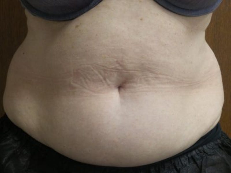 Female Abs Before & After Gallery - Patient 607367 - Image 1