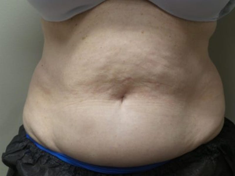 Female Abs Before & After Gallery - Patient 607367 - Image 2