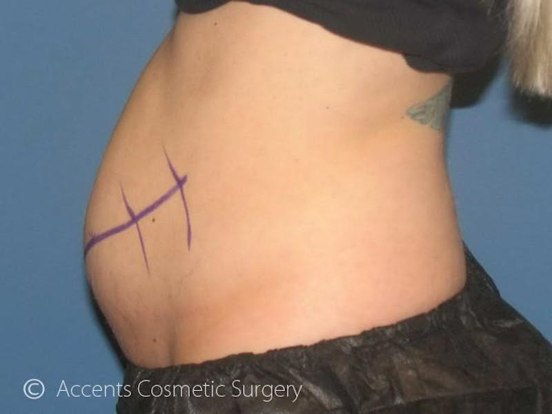 Female Abs Before & After Gallery - Patient 149258 - Image 1