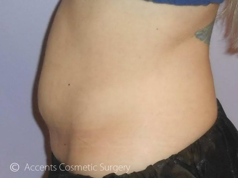 Female Abs Before & After Gallery - Patient 149258 - Image 2