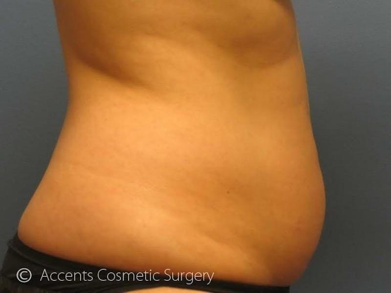 Female Abs Before & After Gallery - Patient 723664 - Image 1