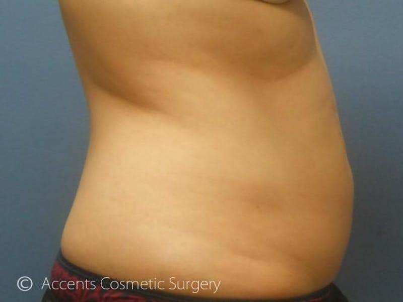 Female Abs Before & After Gallery - Patient 723664 - Image 2