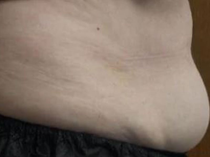 Female Abs Before & After Gallery - Patient 371051 - Image 1