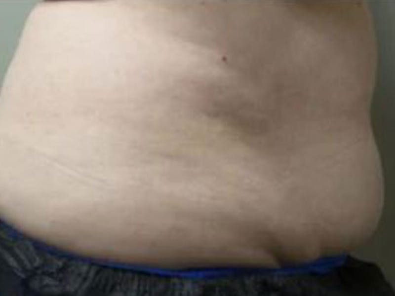 Female Abs Before & After Gallery - Patient 371051 - Image 2