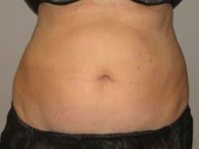 Female Abs Before & After Gallery - Patient 255174 - Image 1