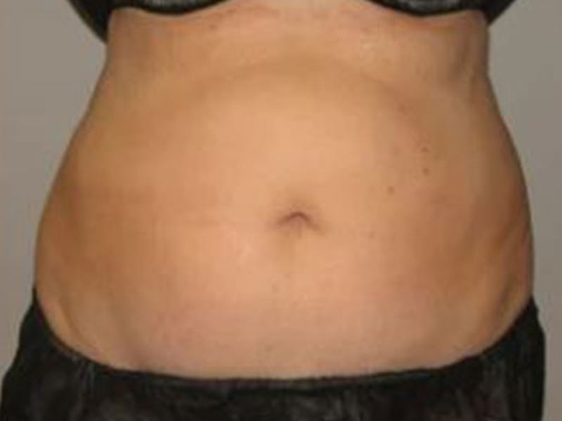 Female Abs Before & After Gallery - Patient 255174 - Image 1