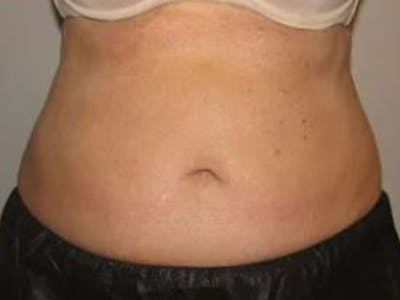 Female Abs Before & After Gallery - Patient 255174 - Image 2