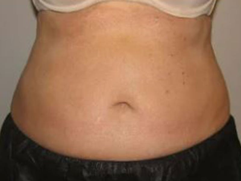 Female Abs Before & After Gallery - Patient 255174 - Image 2
