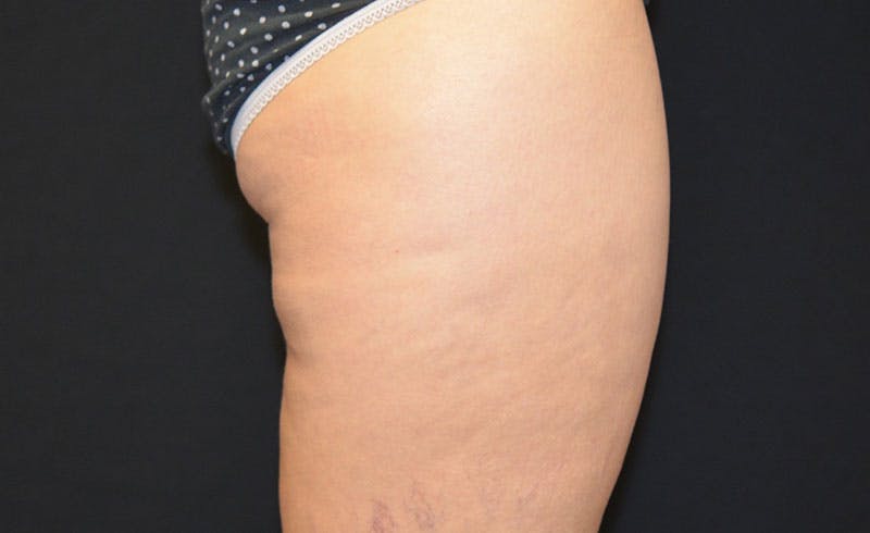Female Banana Roll Before & After Gallery - Patient 420853 - Image 1