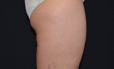 Female Banana Roll Before & After Gallery - Patient 420853 - Image 2