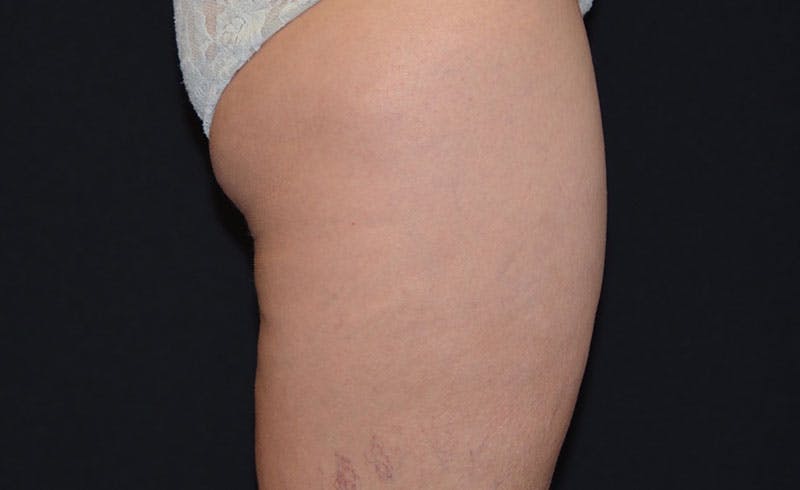 Female Banana Roll Before & After Gallery - Patient 420853 - Image 2