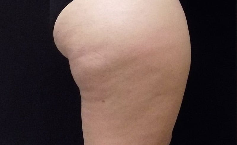 Female Banana Roll Before & After Gallery - Patient 778697 - Image 1