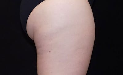 Female Banana Roll Before & After Gallery - Patient 778697 - Image 2