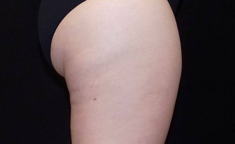 Female Banana Roll Before & After Gallery - Patient 778697 - Image 2