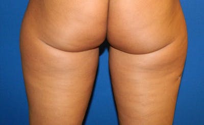 Female Banana Roll Before & After Gallery - Patient 104486 - Image 1
