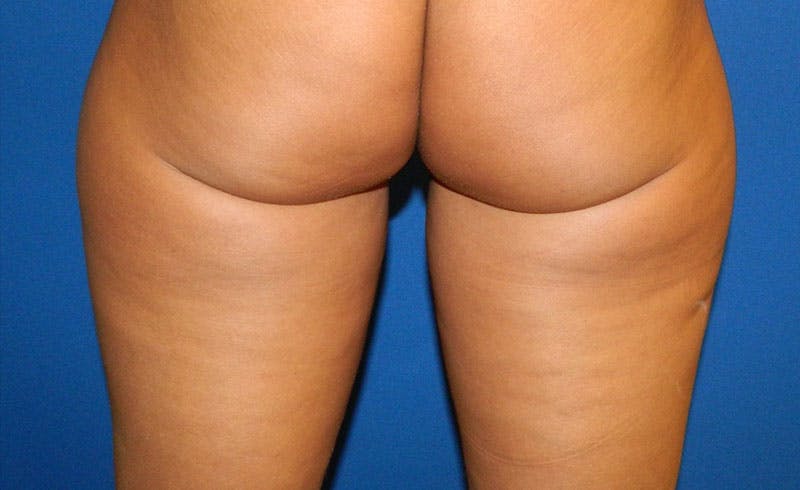 Female Banana Roll Before & After Gallery - Patient 104486 - Image 1