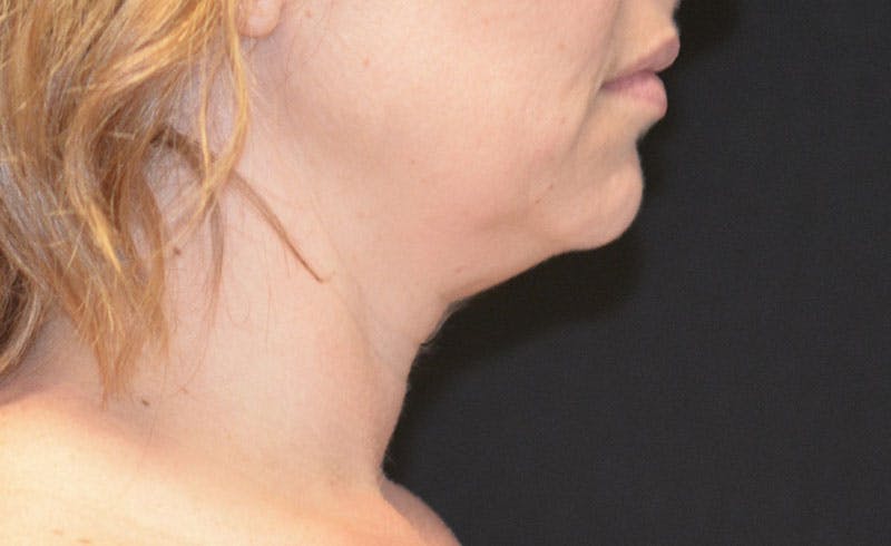 Female Double Chin Before & After Gallery - Patient 264187 - Image 1