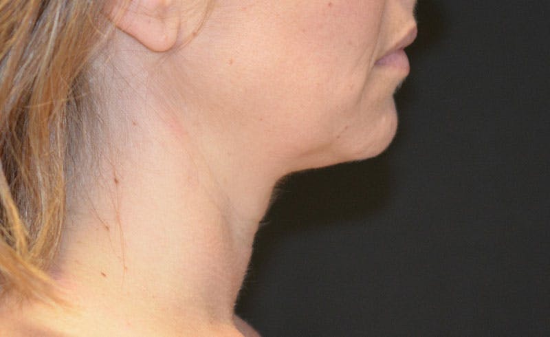 Female Double Chin Before & After Gallery - Patient 264187 - Image 2