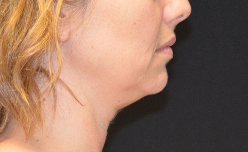 Female Double Chin Before & After Gallery - Patient 563778 - Image 1