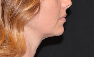 Female Double Chin Before & After Gallery - Patient 563778 - Image 2