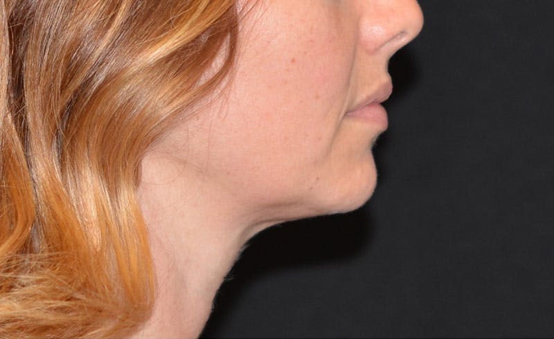 Female Double Chin Before & After Gallery - Patient 563778 - Image 2