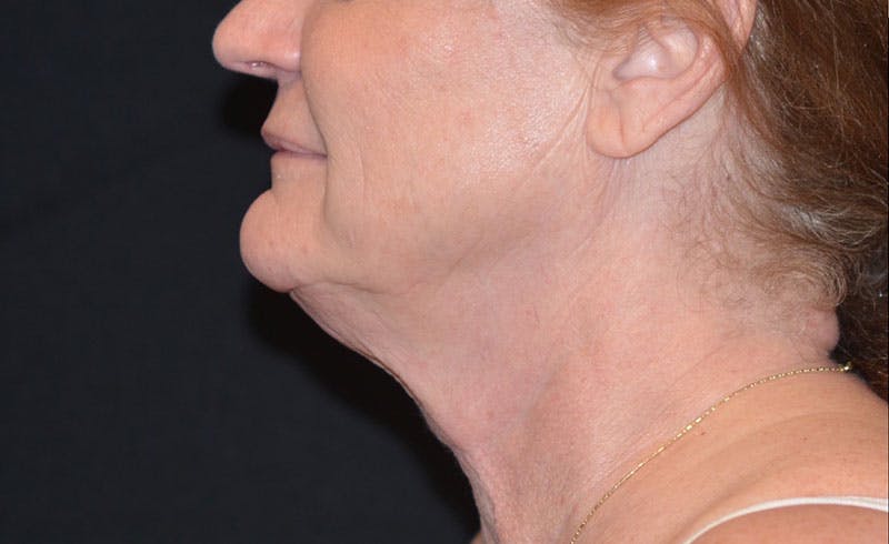 Female Double Chin Before & After Gallery - Patient 229669 - Image 1