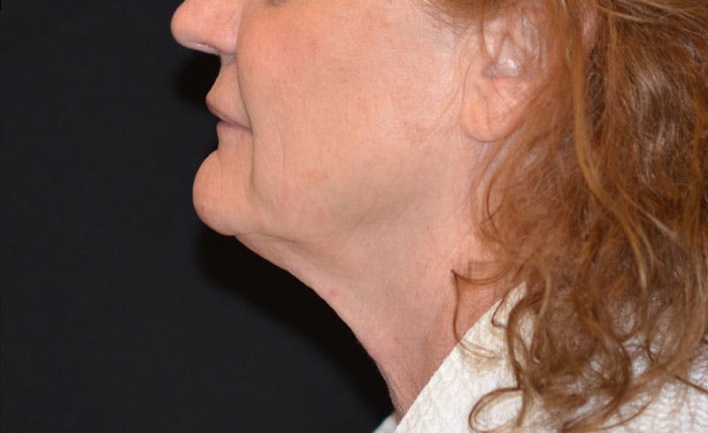 Female Double Chin Before & After Gallery - Patient 229669 - Image 2
