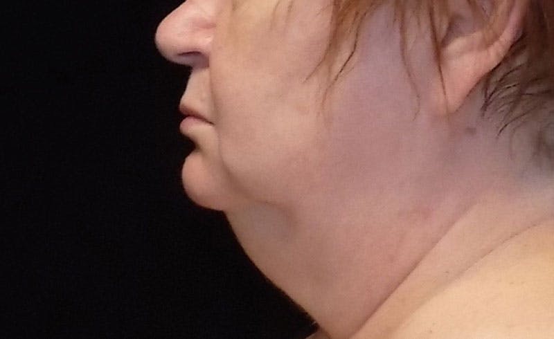 Female Double Chin Before & After Gallery - Patient 680367 - Image 1