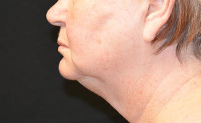 Female Double Chin Before & After Gallery - Patient 680367 - Image 2
