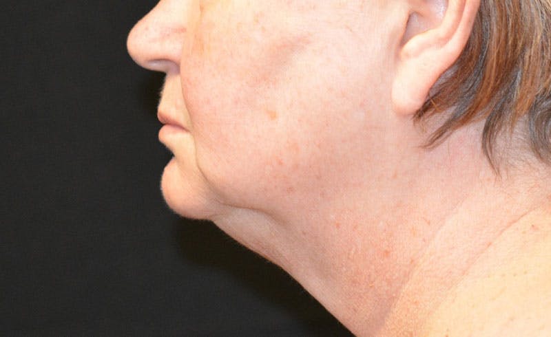 Female Double Chin Before & After Gallery - Patient 680367 - Image 2